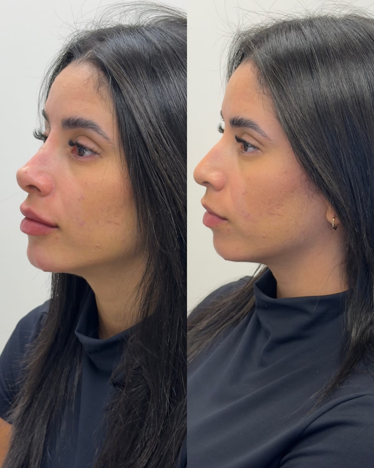 Comparativo de perfil facial antes e depois do tratamento